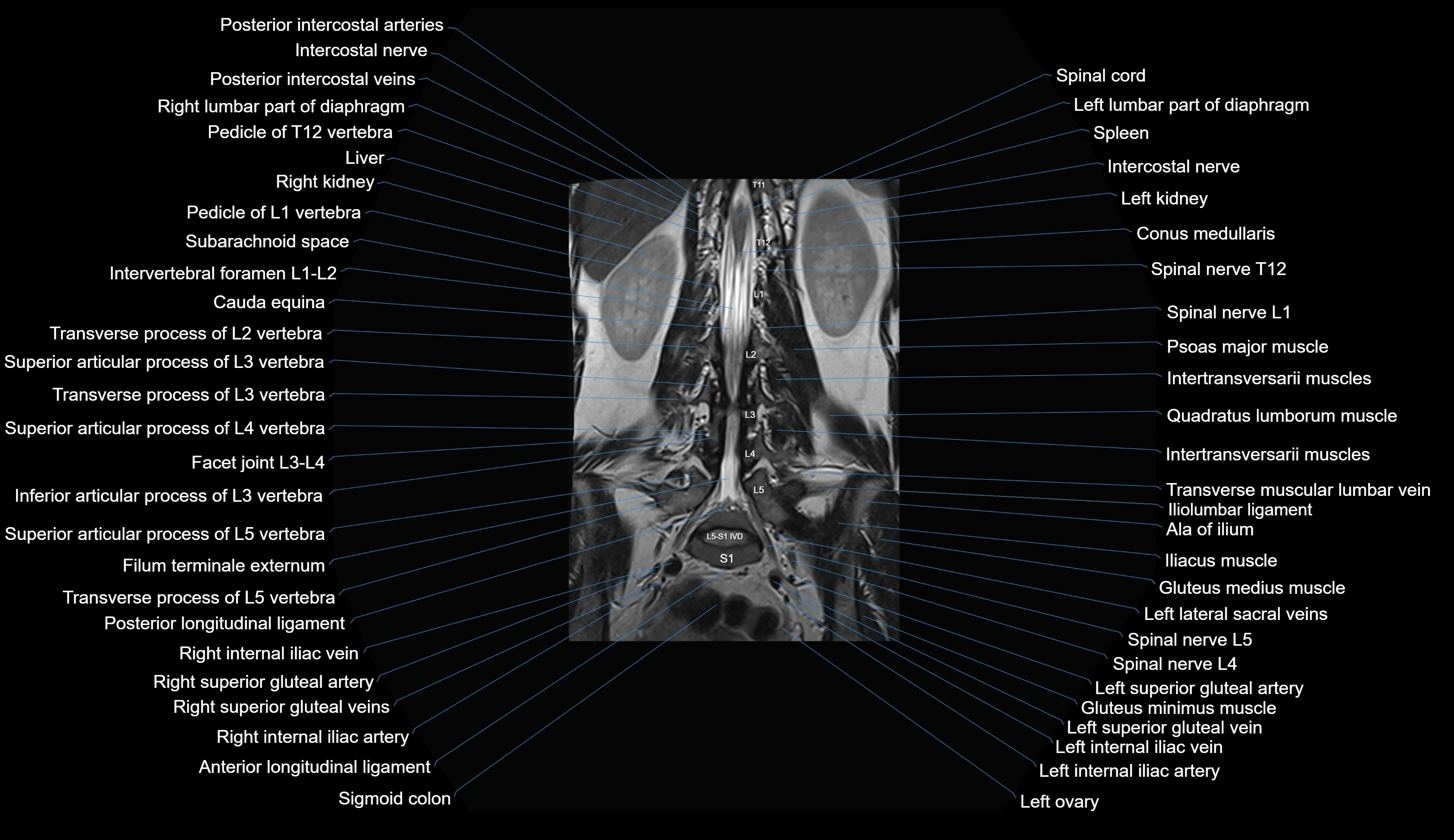 MRI lumbar spine coronal cross sectional anatomy 3T radiology  image-img-00001-00020.webp